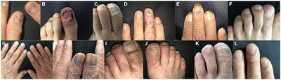 Nail changes in pemphigus and bullous pemphigoid: A single-center study in China